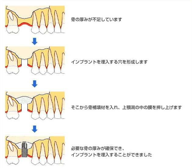 ソケットリフト法